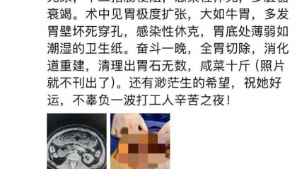女子多器官衰竭、整个胃被摘除，医生清理出10斤……紧急提醒