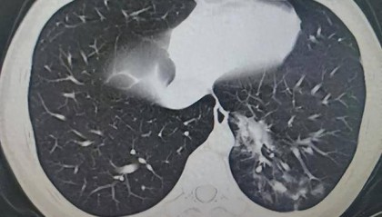 14岁男生4天高烧不退！一查不是甲流，竟是这种感染